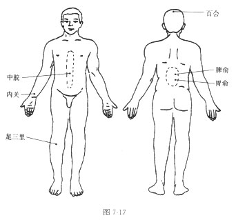 砭石調(diào)理胃下垂